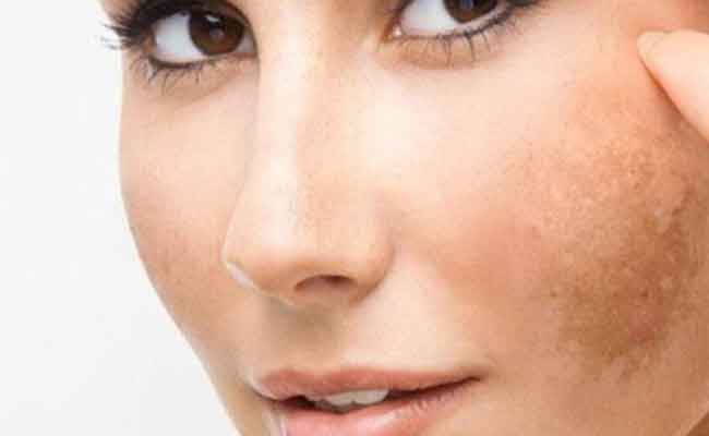 هل هناك علاجات فعّالة لكلف الحمل؟…