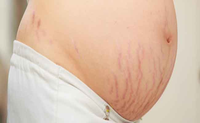 في أيّ أسبوع تبدأ تشققات البطن بالظهور عند الحامل؟…
