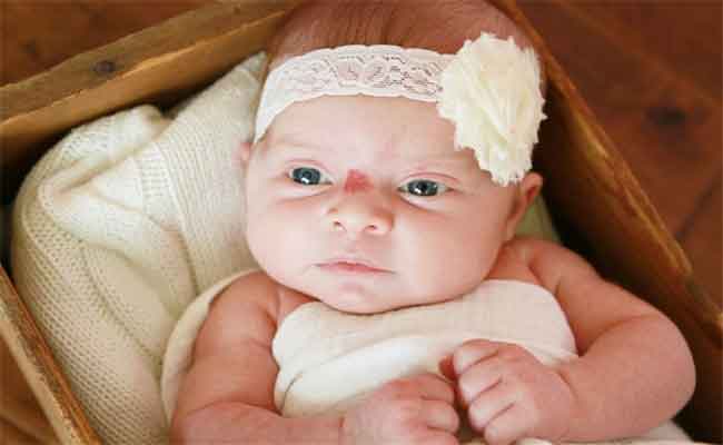 ما هي الوحمة عند الرضيع؟ ومتى تتطلّب علاجاً طبياً؟…