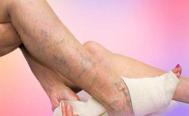 ما هو النظام الغذائي الذي يساعد في التخفيف من أعراض الدوالي؟…