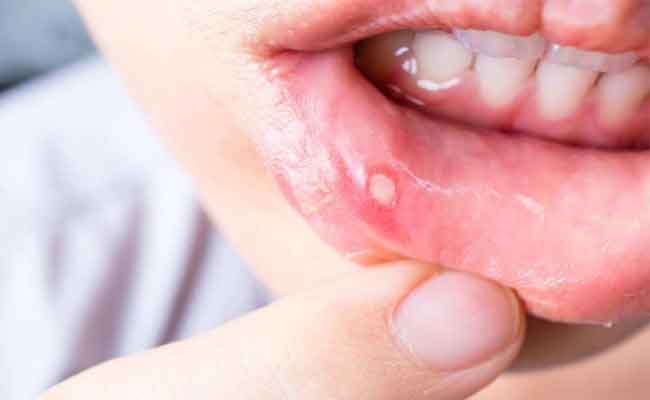 كلّ ما يجب أن تعرفيه حول تقرّحات الفم خلال الحمل وطرق علاجها!…