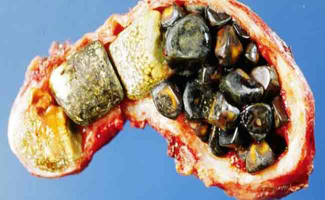 هذه الأطعمة يجب أن تتجنّبوها اذا كنتم تعانون من حصوات المرارة…!