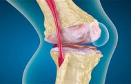 طرق طبيعية وطبية وجراحية لعلاج خشونة الركبة...تعرّفوا عليها