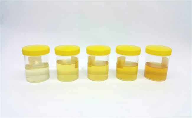 ما الذي تشير اليه رائحة البول الكريهة عند الحامل؟