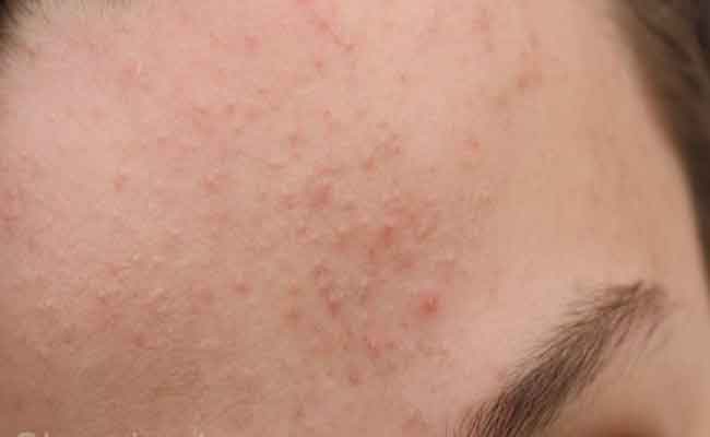 إليك 7 طرق لمعالجة حبوب البشرة الدهنيّة…