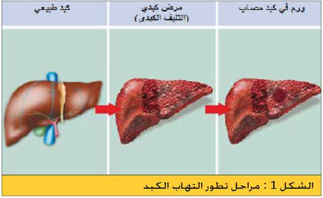 هل حامل فيروس الكبد الوبائي مُعدٍ؟…