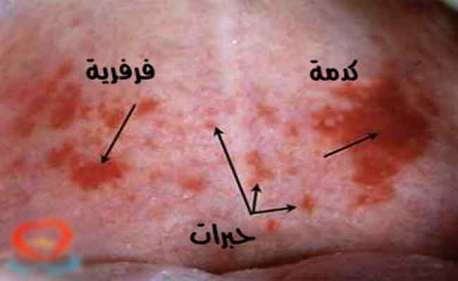 تأثيرات لافتة يجب أن تعرفوها للصدفية على حياتكم الجنسية!