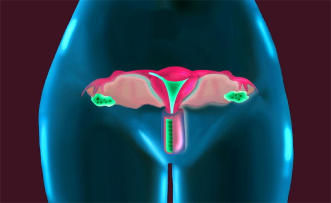 7 أسباب شائعة لآلام الحوض عند النساء…!