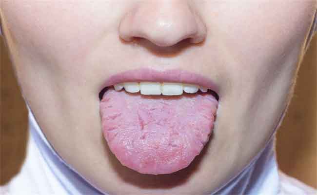 “لسان كورونا”…هل هو احد الأعراض الجديدة للفيروس التاجي؟