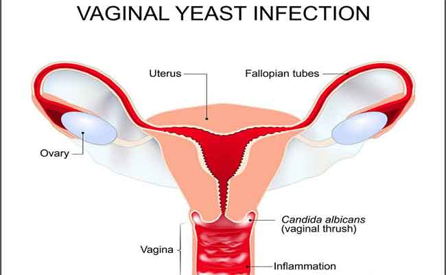 للوقاية من فطريات المهبل…6 نصائح وخطوات ضرورية!
