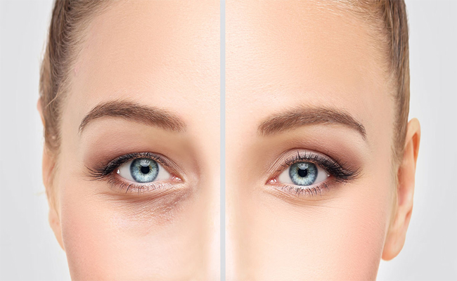 كيف يمكن أن تحافظوا على نتائج عملية شدّ الجفون؟…