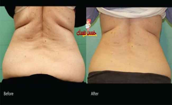 لحرق دهون الظهر…الإلتزام بهذا الرجيم هو الحلّ!