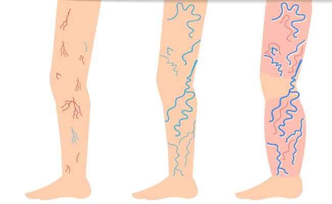 4 علاجات منزلية فعّالة تساعدكم في التخلّص من الدوالي…!