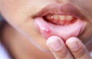 أي علامات تشير الى اصابتكم بعدوى الخميرة في الفم؟
