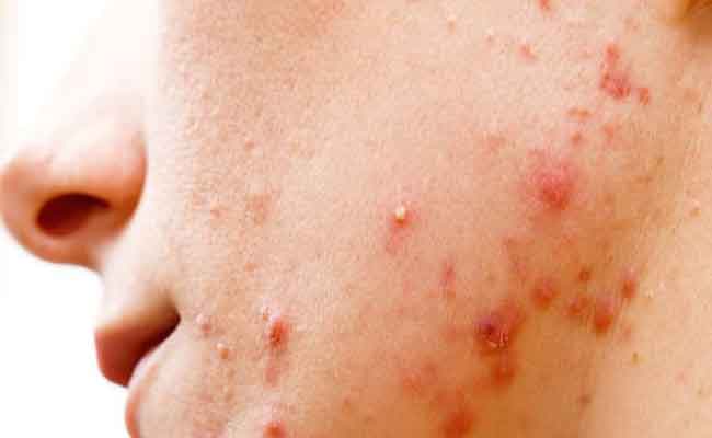 بشرة نضرة وخالية من الشوائب…كلّها بفضل زيت جوز الهند!