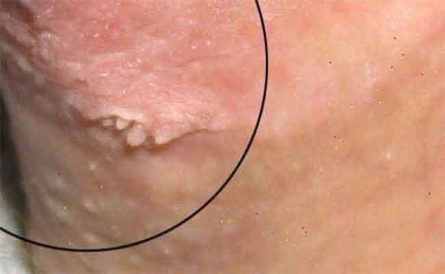 ما هي الطرق المتاحة لعلاج الثآليل التناسلية؟