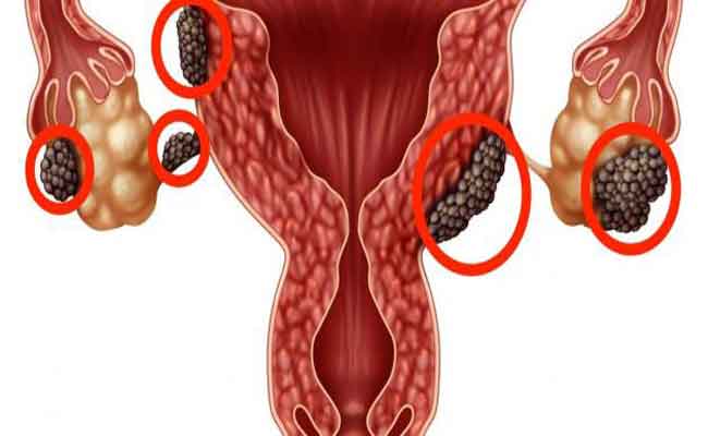 علامات شائعة تدلّ على الإصابة بالانتباذ البطاني الرحمي…