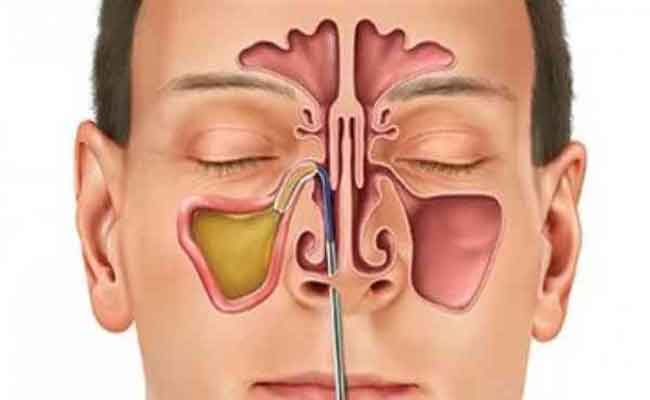 ما هي العلاجات المتاحة لإلتهاب الجيوب الانفية؟