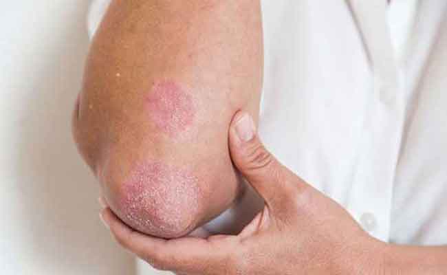 لماذا يعاني مريض الصدفية من ضعف الانتصاب؟