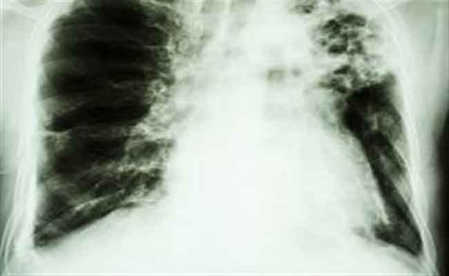 كيف تحمون أنفسكم من مرض الدرن؟