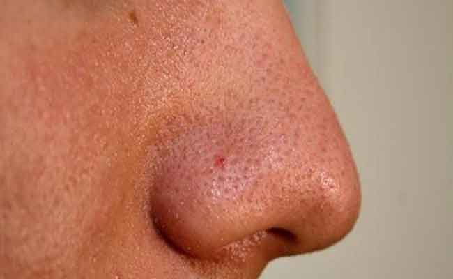 كيف تخفّفين من مشكلة المسام الواسعة في بشرتكِ الدهنية؟