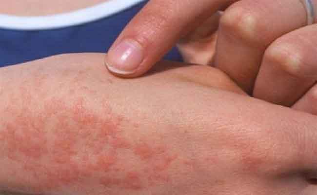 تسجيل إصابة 31 شخصا بالحمى المالطية بباتنة