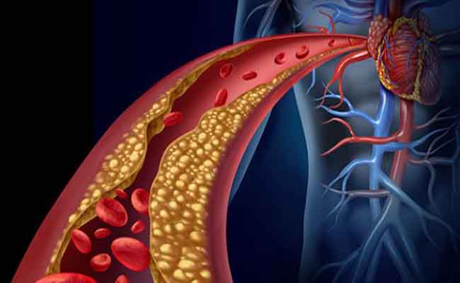 كلّ ما يجب أن تعرفوه عن الكولسترول الوراثي وطريقة علاجه…