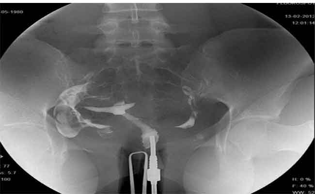 كيف يمكن ان تضرّ اشعة الصبغة الرحم؟