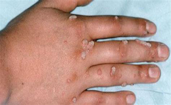 تعرّفوا على أسباب ظهور الثآليل …