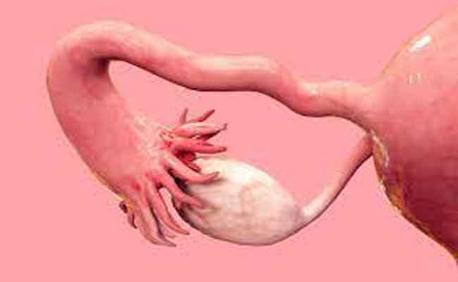 هل صحيح ان تكيس المبايض يمنع الدورة الشهرية؟