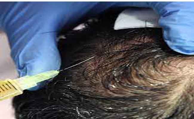 كيف تساعد تقنية البلازما الغنية بالصفائح الدموية على معالجة تساقط