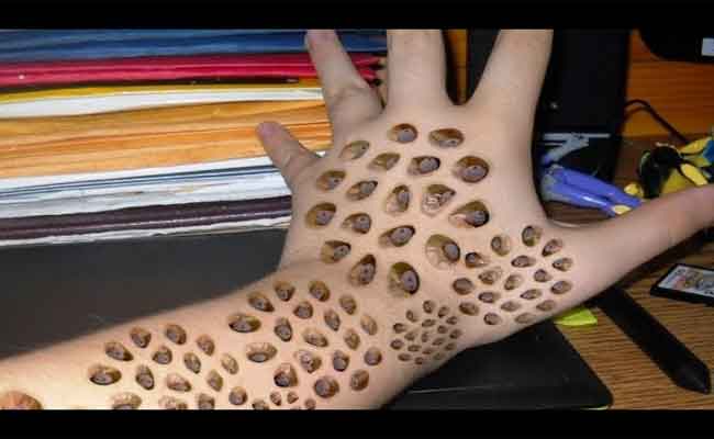 ما هي فوبيا الثقوب؟ وهل من علاج لها؟