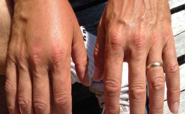 ما هي شروط رجيم التخلص من احتباس الماء؟