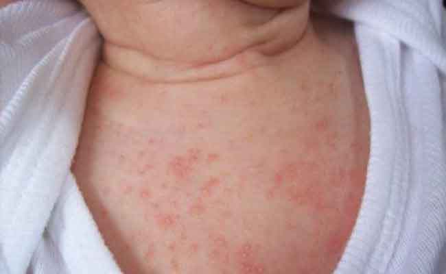 خطوات ونصائح هامة لعلاج الحساسية الجلدية عند الطفل