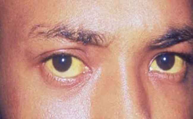 ما هي الأطعمة المفيدة لمريض الصفراء والتي تسرّع عملية شفائه؟