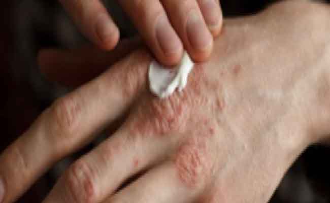 كيف تؤثر اصابتكم بالأكزيما على صحتكم النفسية؟