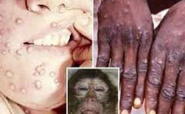 ما هو فيروس جدري القرود؟ وما مدى خطورته؟