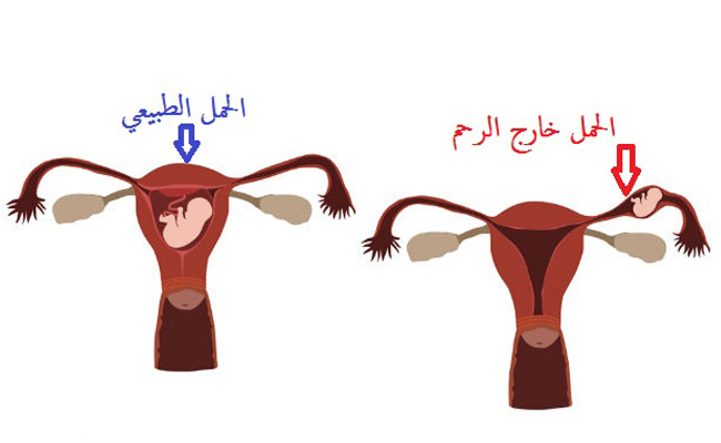 ما هو الحمل خارج الرحم؟