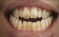 لماذا تظهر البقع البنيّة على الأسنان؟