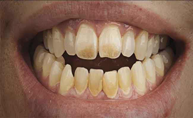 لماذا تظهر البقع البنيّة على الأسنان؟