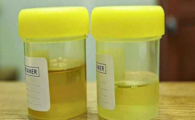 ما هو اللون الطبيعي للبول عند الطفل؟ ومتى يتغير؟