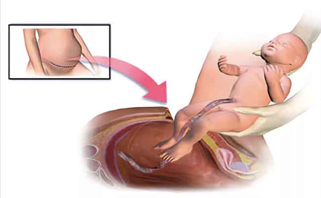 كيف تستعدّين بشكلٍ صحيح للولادة القيصرية؟