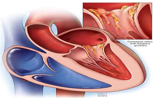 هل تسبّب الإصابة بفيروس كورونا التهابات القلب؟