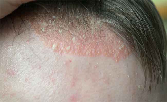 ما هي الخيارات العلاجية المتاحة لالتهاب فروة الرأس؟