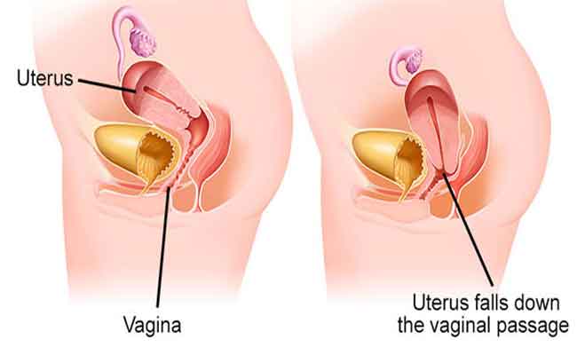 ما هي الأعراض الأكثر شيوعاً لهبوط الرحم؟