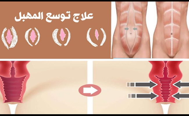 هل المهبل الواسع من المشاكل الشائعة بعد الولادة؟