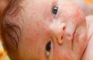 الحبوب يمكن أن تغزو وجه طفلكِ الرضيع...ما السبب وراء ذلك؟