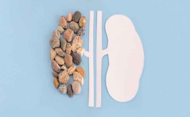 أي أطعمة تساعد على منع تكوّن حصى الكلى؟