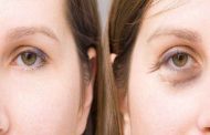 ما هي اجراءات التجميل التي يمكن اعتمادها للتخلص من التجاعيد حول العينين؟