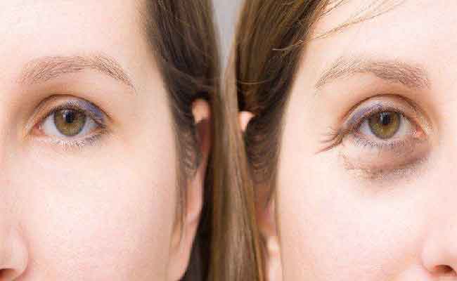 ما هي اجراءات التجميل التي يمكن اعتمادها للتخلص من التجاعيد حول العينين؟